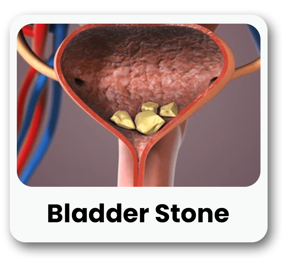 Bladder stone